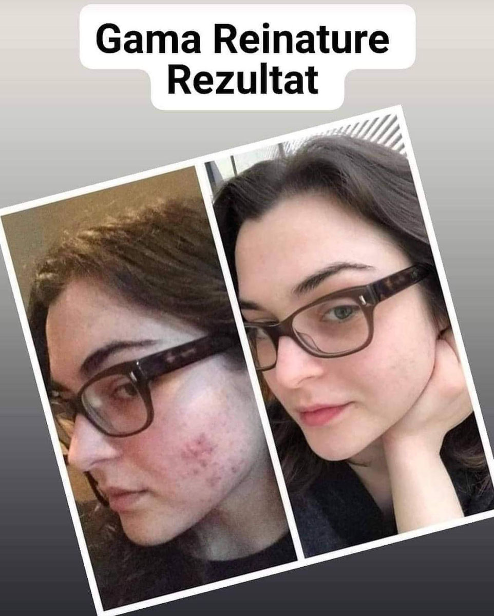 Set tratament pentru cei care au probleme acnee pete pigmentare foto 6
