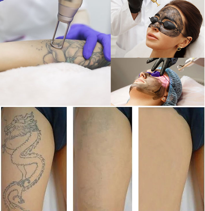 Аппарат для удаления татуировок ND YAG лазер YL-500 Dispozitiv de îndepărtare a tatuajelor laser foto 7