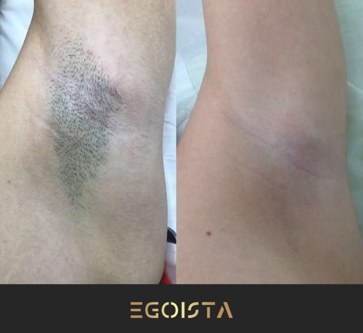 Лазерная эпиляция без боли уже Молдове! Вместе с Egoista Spa Center! фото 8