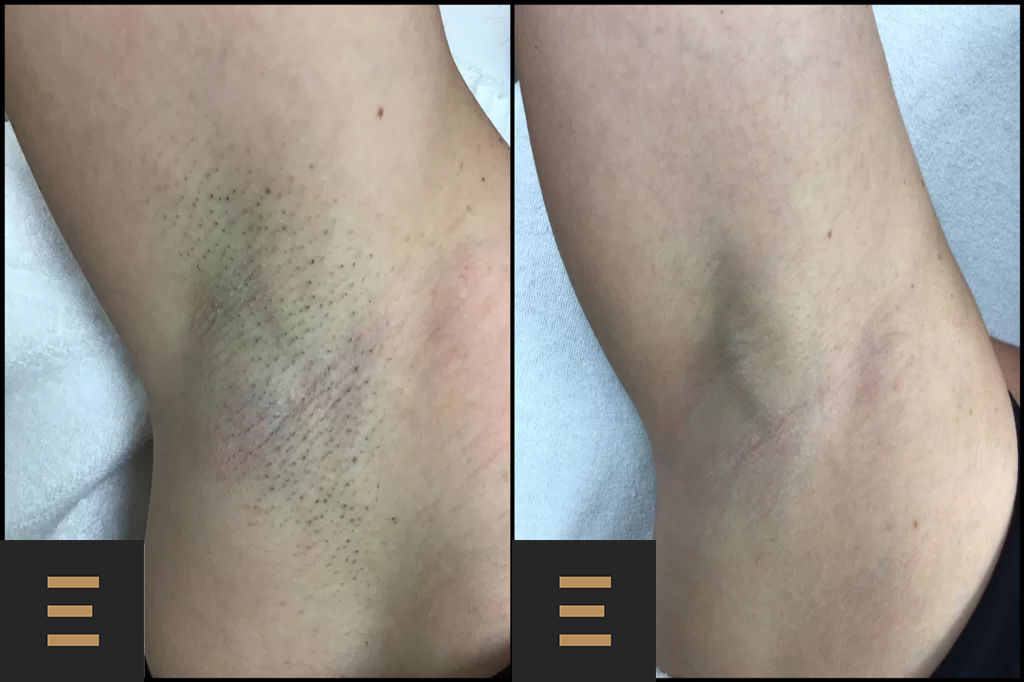 Epilare cu laser fără durere, acum în Moldova! Doar la Egoista Spa Center! foto 6