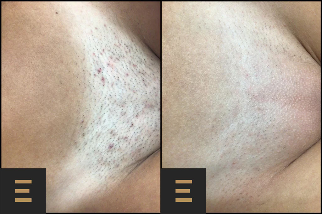 Лучший лазер для эпиляции в Молдове! Немецкое качество с Mediostar Monolith Asclepion Laser foto 1