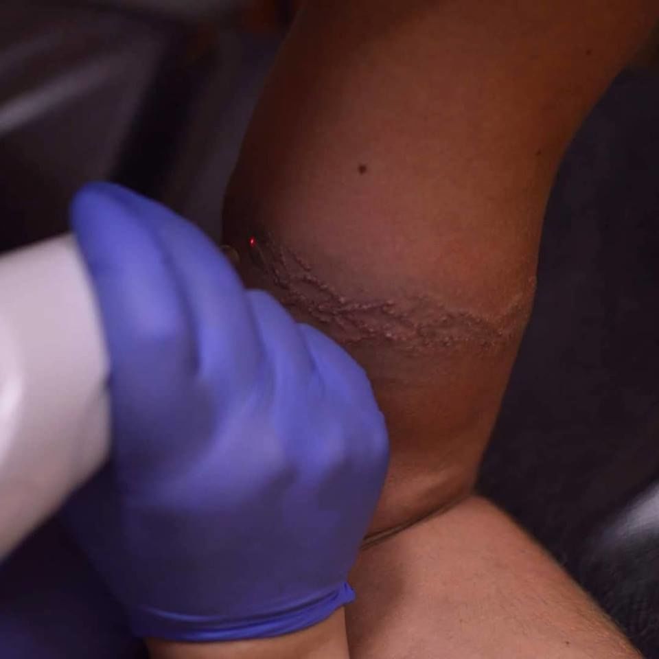 Removal tatt!Eliminarea tatuajelor cu laser Mad-art in Chisinau.Лазерное удаление татуировок Кишинёв foto 4