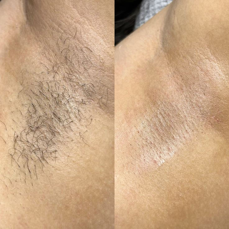 Epilare sugaring/ceara sec. Buiucani foto 5