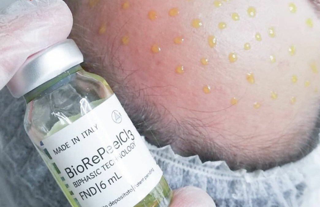 BioRePeelCl3- procedura de top,Buiucani foto 0