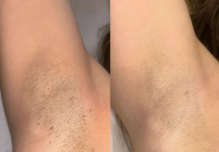 Egoista Spa – Cel mai bun laser de îndepărtare a părului din Chișinău este acum la noi! foto 0