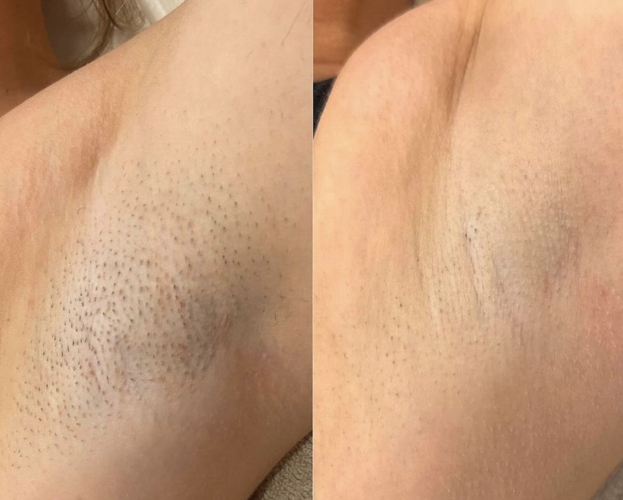 Epilare cu laser fără durere, acum în Moldova! Doar la Egoista Spa Center! foto 4