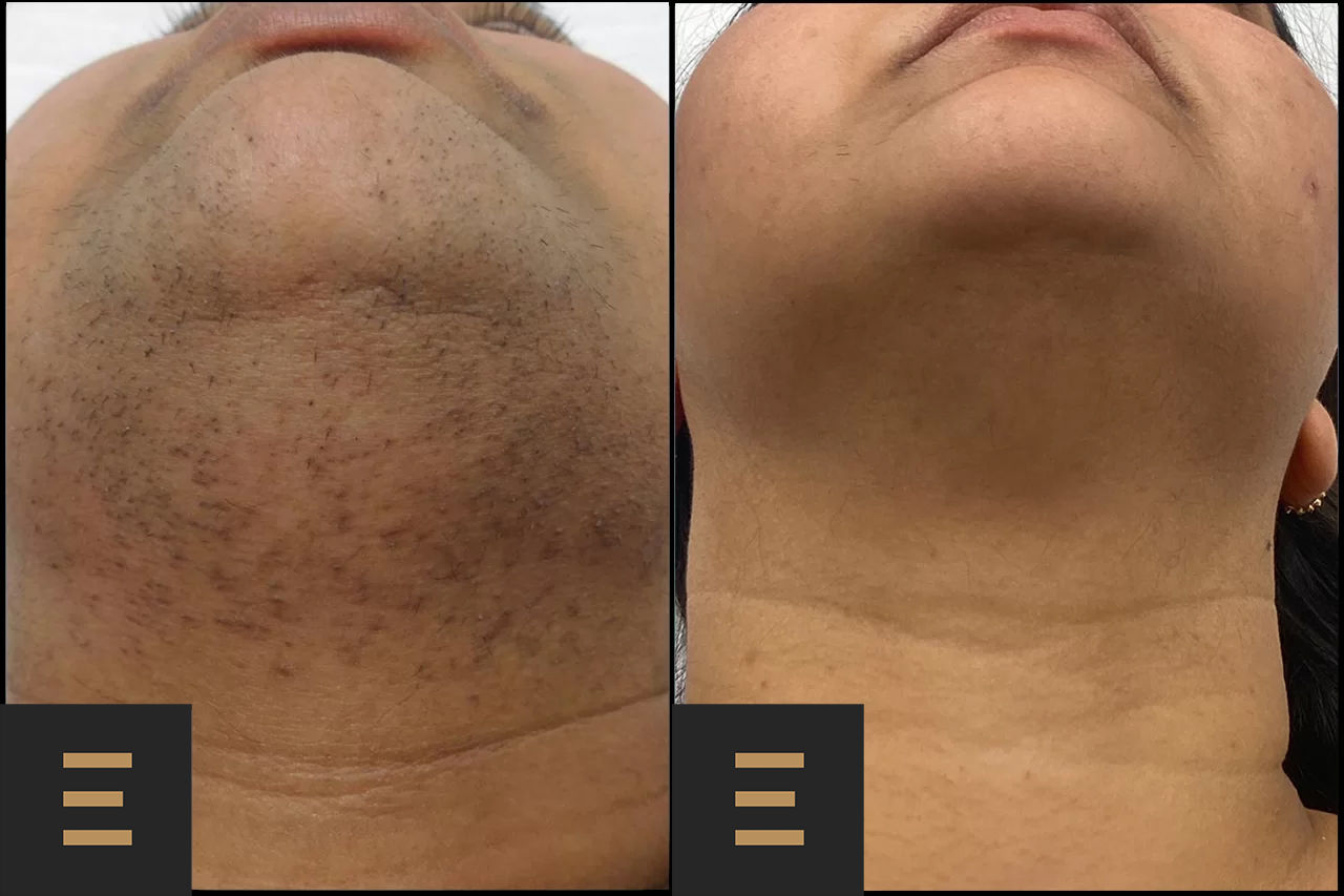 Egoista Spa – Cel mai bun laser de îndepărtare a părului din Chișinău este acum la noi! foto 1