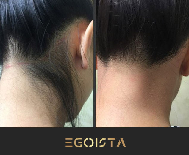 Epilare cu laser în Chișinău: studio "Egoista" în Botanica – programați-vă pentru netezime! фото 2