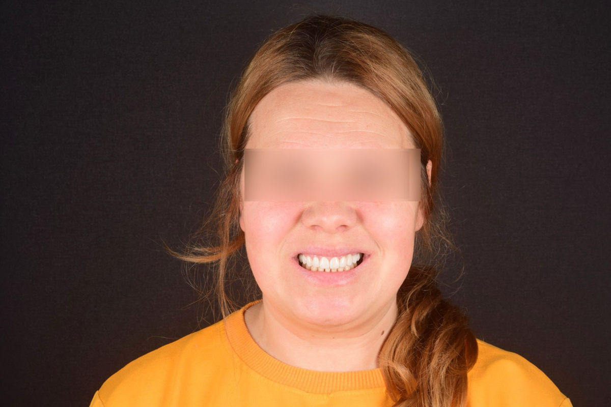  Implant dentar la pret adecvat.  foto 0