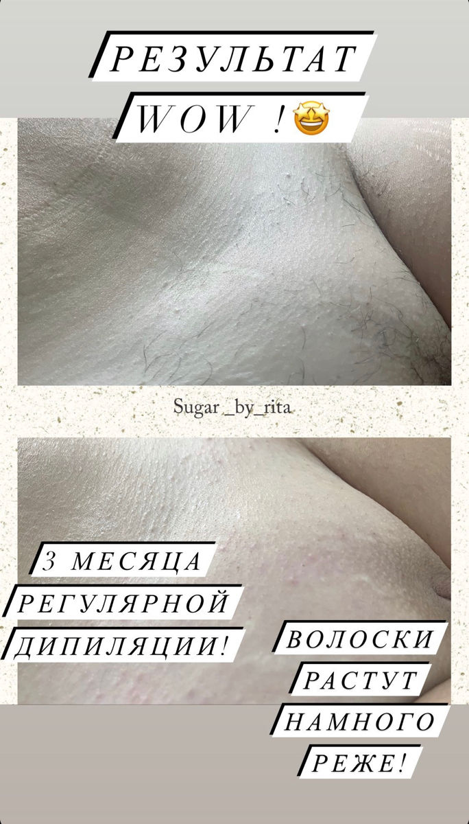 Мужская и женская депиляция/шугаринг/пилинг тела foto 5