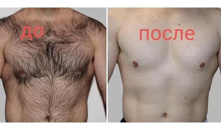 Шугаринг / Мужская сахарная депиляция foto 4