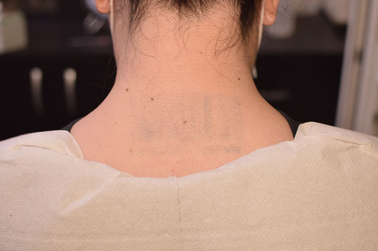 Removal tatt!Eliminarea tatuajelor cu laser Mad-art in Chisinau.Лазерное удаление татуировок Кишинёв foto 6