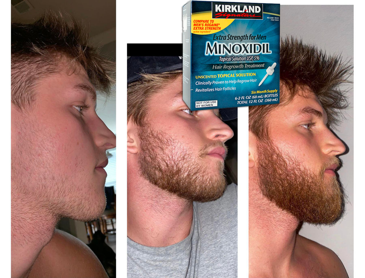 Миноксидил побочные. Миноксидил для бороды. Minoxidil для бороды. Миноксидил для волос бороды. Густая борода миноксидил.