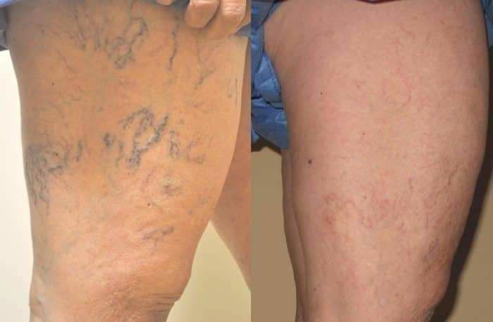 medicina eficienta din venele varicoase într-o farmacie
