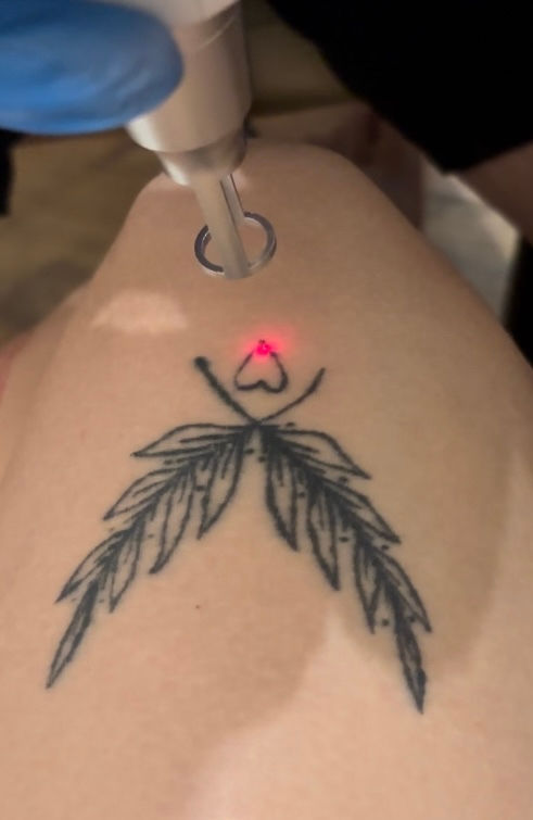 Удаление тату лазером, Ștergerea tattoo cu laser foto 1