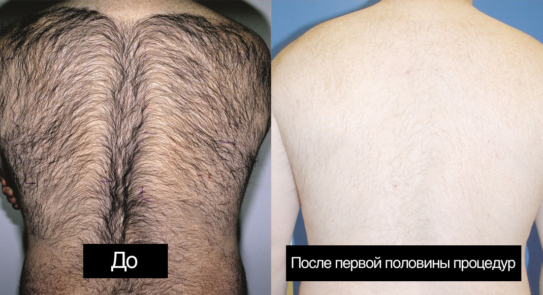 Лазерная эпиляция без боли уже Молдове! Вместе с Egoista Spa Center! фото 2