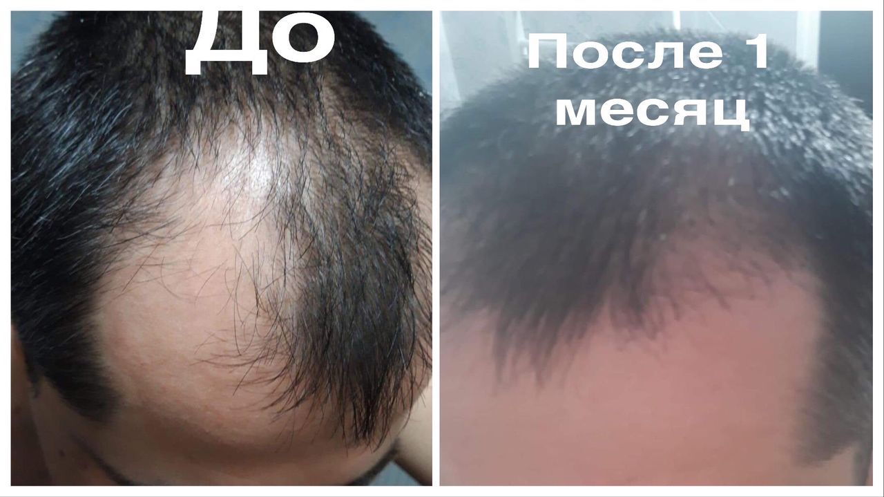 Minoxidil 15% / Миноксидил 15%