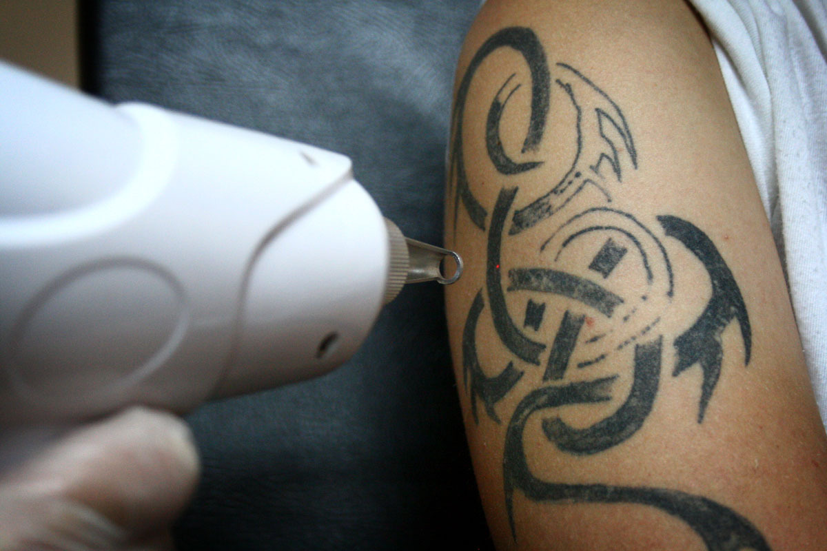 Removal tatt!Eliminarea tatuajelor cu laser Mad-art in Chisinau.Лазерное удаление татуировок Кишинёв foto 1