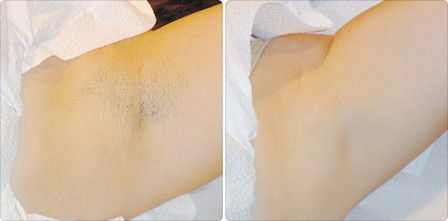 Epilator IPL,Rejuvenare,Curatare acnee, Alb Фотоэпилятор IPL foto 13