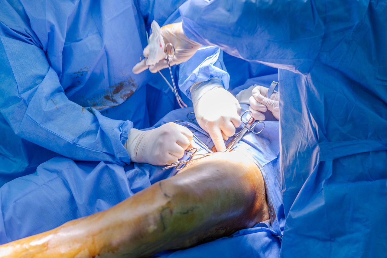 chirurgie chirurgicala varicoasa)