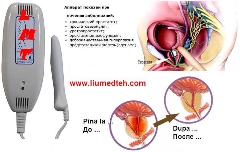 tratamentul prostatitei magnet