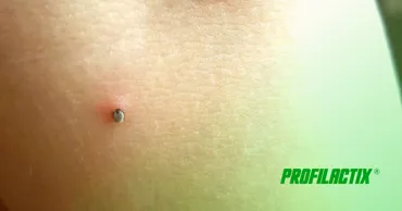 Profilactix: Клещи появились раньше в этом году, как от них защититься Ⓟ