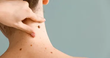 Când devin alunițele un motiv de îngrijorare și ce recomandă dermatologii