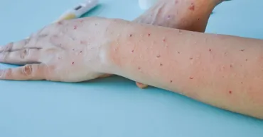 Cazurile de rujeolă din SUA au atins un nivel-record în ultimii 35 de ani