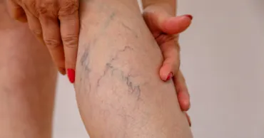 Cum poate fi prevenită tromboza și care sunt factorii de risc? Sfaturile unui medic
