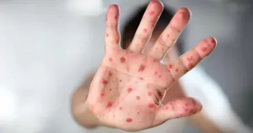 Un caz de rujeolă, confirmat la un copil din Chișinău