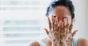 Vitiligo, boala petelor albe: De ce apare și ce tratamente recomandă medicii