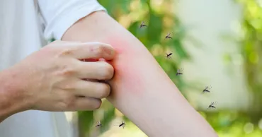De ce nu e bine să ne scărpinăm după ce ne-a ciupit o insectă