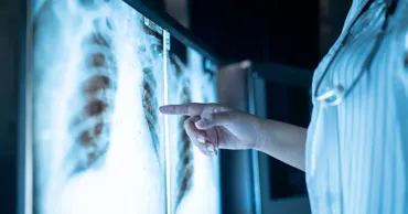 Studiu: COVID-19 și gripa pot crește riscul de dezvoltare a cancerului