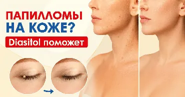 Diasitol поможет от папилломы на коже Ⓟ