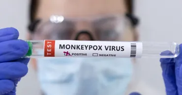 Un caz de import de infecție cu virusul variolei maimuței, înregistrat în Republica Moldova