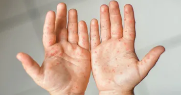 Noi cazuri de rujeolă, confirmate în municipiul Chișinău: Toate persoanele sunt nevaccinate
