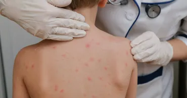 Avertisment după moartea unui copil de 5 ani: Varicela nu este o boală banală
