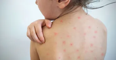 В Кишинёве зарегистрирован первый случай кори в 2026 году