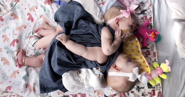 Siameze care aveau inimile lipite au supraviețuit operației de separare