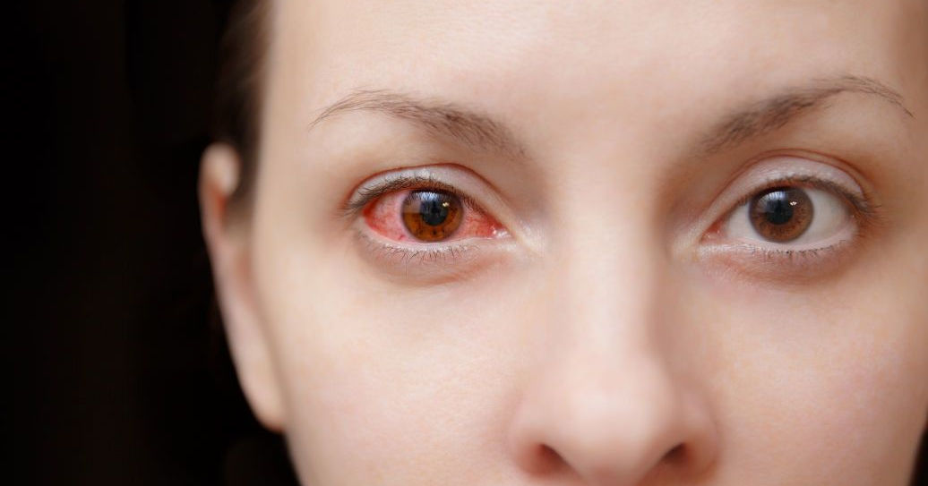 Синдром покрасневшего глаза