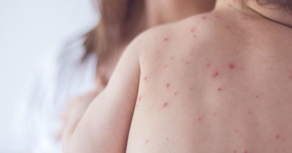 В Запорожье зарегистрировано 4 случая кори среди работников больницы.