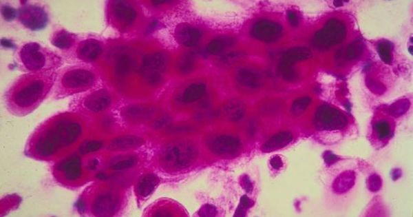 Vaccinul anticancer începe să fie testat pe oameni. Foto: Digi24