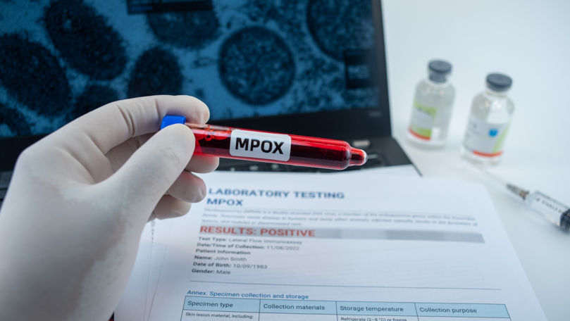 Două cazuri de infectare cu mpox, raportate în Macedonia de Nord