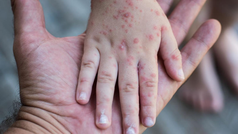 ANSP: 172 de cazuri de rujeolă, înregistrate de la începutul anului