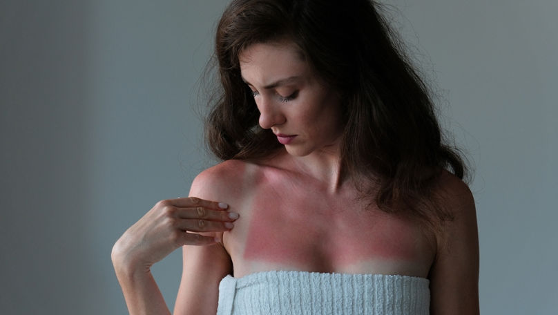Cinci remedii rapide în cazul arsurilor solare. Cele mai bune sfaturi