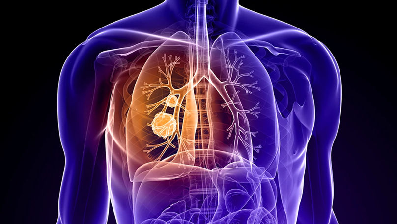 Tot mai mulți nefumători fac cancer pulmonar: Ce ar trebui să știi