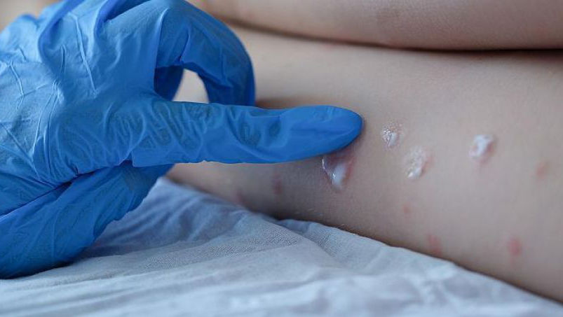 Primul caz de variola maimuței, înregistrat în Republica Moldova