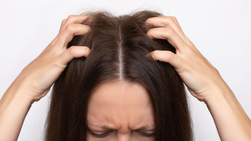 Diferența dintre mătreață și psoriazis. Când să consulți un specialist