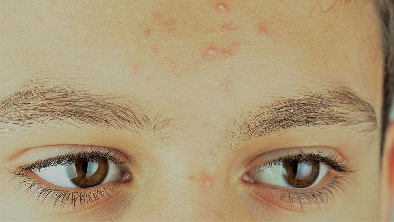 Primul vaccin contra acneei e mai aproape decât credeai