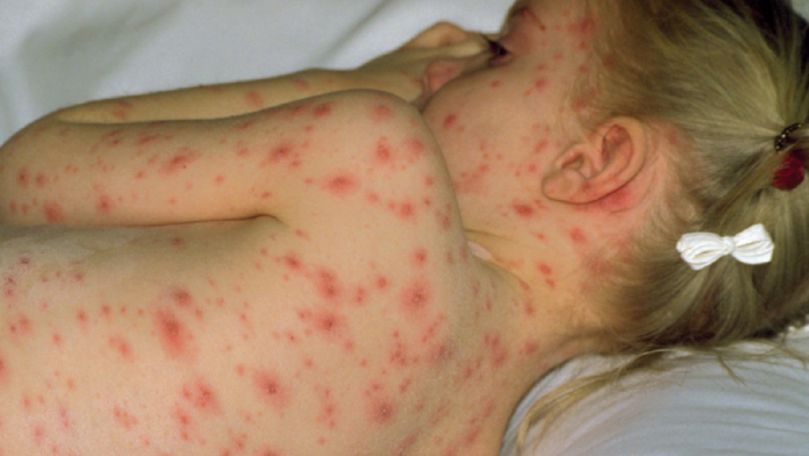 Avertisment: O boală extrem de gravă se răspândește în Moldova